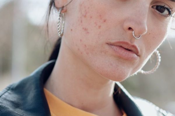 When Is It Advisable to Make Use of best scar cream After Rhinoplasty?